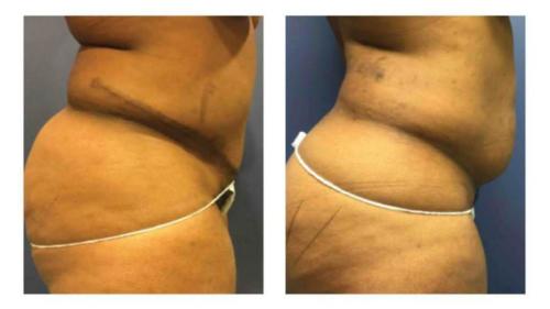 Tummy-Tuck-Liposuction-1 Before-After Dr-Gerald-Ginsberg
