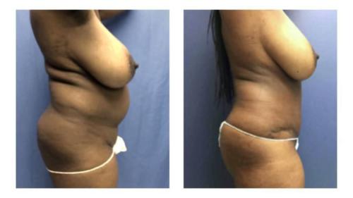 Tummy-Tuck-Liposuction-1 Before-After Dr-Michael-Jones