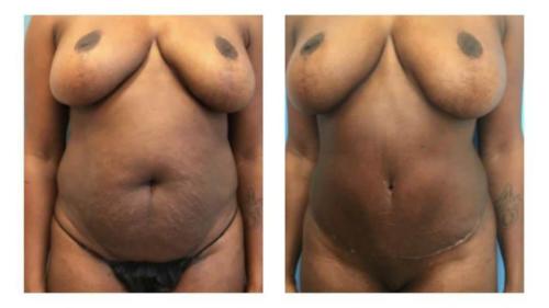 Tummy-Tuck-Liposuction-1 Before-After Dr-Nicholas-Jones