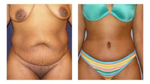 Tummy-Tuck-Liposuction-20 Before-After Dr-Michael-Jones