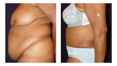 Tummy-Tuck-Liposuction-21 Before-After Dr-Michael-Jones