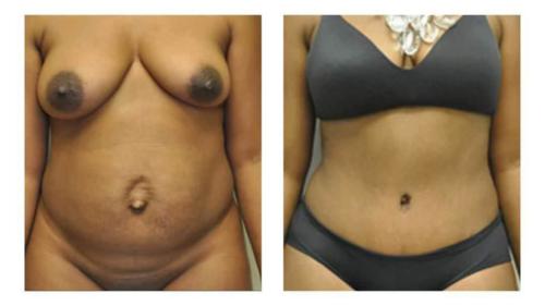 Tummy-Tuck-Liposuction-22 Before-After Dr-Michael-Jones