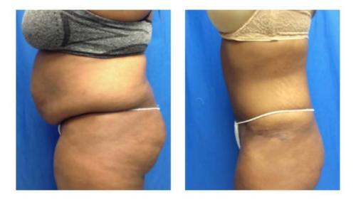 Tummy-Tuck-Liposuction-23 Before-After Dr-Michael-Jones