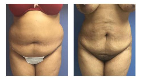 Tummy-Tuck-Liposuction-2 Before-After Dr-Abel-Giorgis