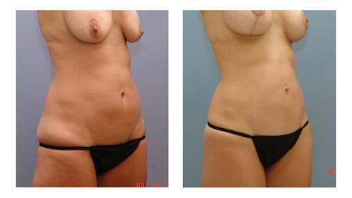 Tummy-Tuck-Liposuction-2 Before-After Dr-Charlie-Chen