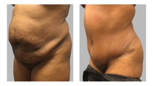 Tummy-Tuck-Liposuction-2 Before-After Dr-Frederick-T-Work