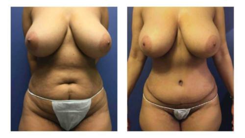 Tummy-Tuck-Liposuction-2 Before-After Dr-Gerald-Ginsberg