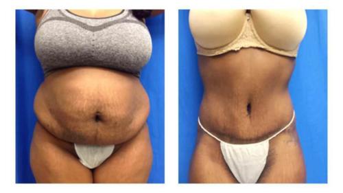 Tummy-Tuck-Liposuction-2 Before-After Dr-Michael-Jones