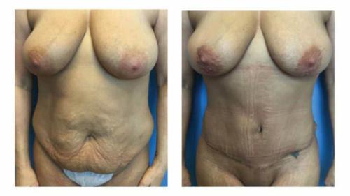 Tummy-Tuck-Liposuction-2 Before-After Dr-Nicholas-Jones