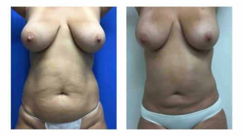 Tummy-Tuck-Liposuction-3 Before-After Dr-Gerald-Ginsberg