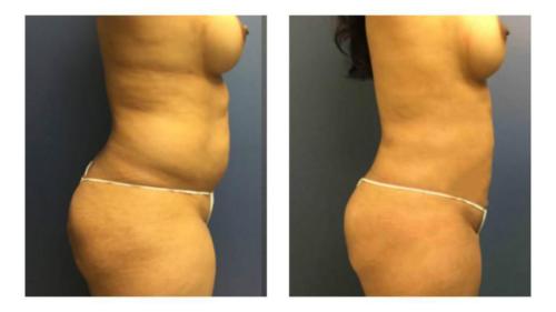 Tummy-Tuck-Liposuction-3 Before-After Dr-Michael-Jones