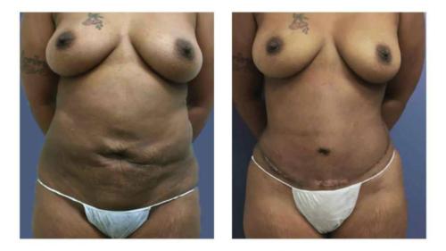 Tummy-Tuck-Liposuction-4 Before-After Dr-Gerald-Ginsberg