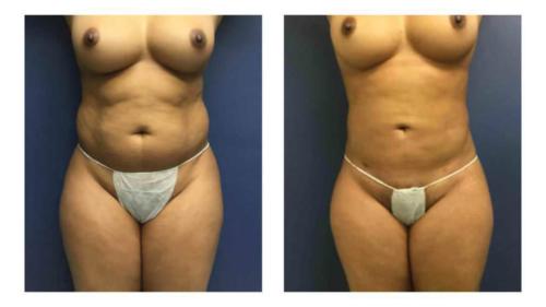 Tummy-Tuck-Liposuction-4 Before-After Dr-Michael-Jones