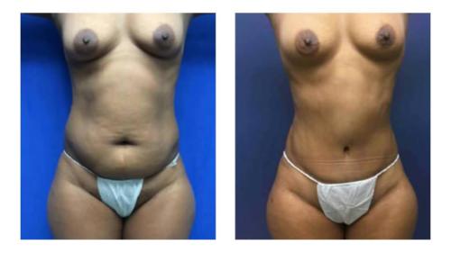 Tummy-Tuck-Liposuction-5 Before-After Dr-Michael-Jones