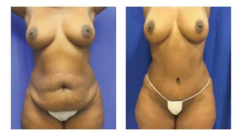 Tummy-Tuck-Liposuction-6 Before-After Dr-Michael-Jones