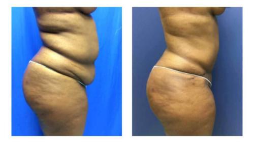 Tummy-Tuck-Liposuction-7 Before-After Dr-Michael-Jones