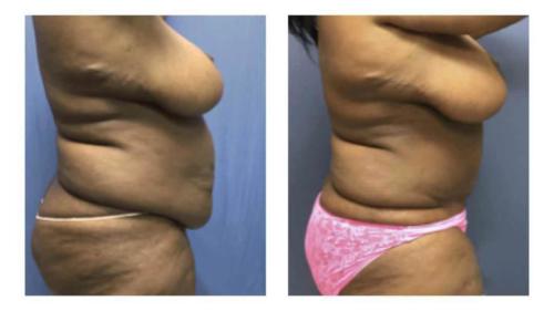 Tummy-Tuck-Liposuction-8 Before-After Dr-Michael-Jones