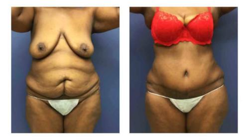 Tummy-Tuck-Liposuction-9 Before-After Dr-Michael-Jones